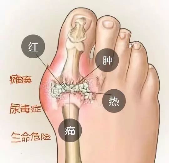 痛风专科